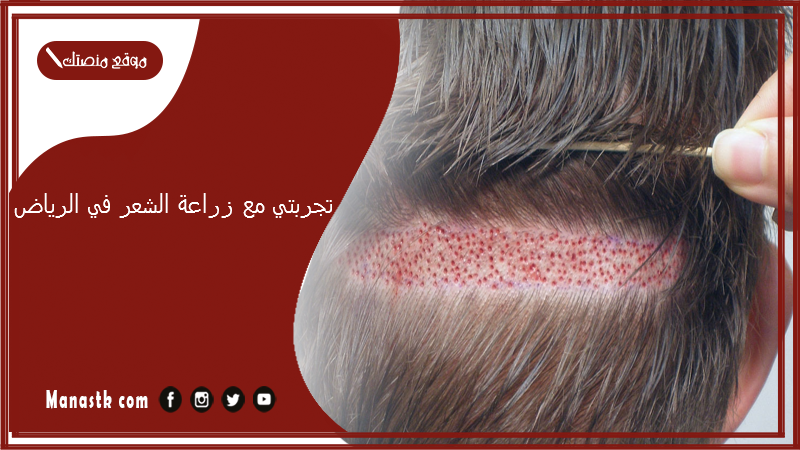 تجربتي مع زراعة الشعر في الرياض.. عيوب زراعة الشعر