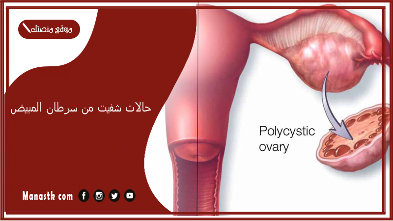 حالات شفيت من سرطان المبيض